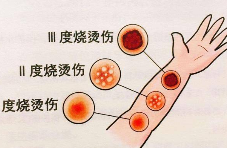 烫伤事故的应急与救护